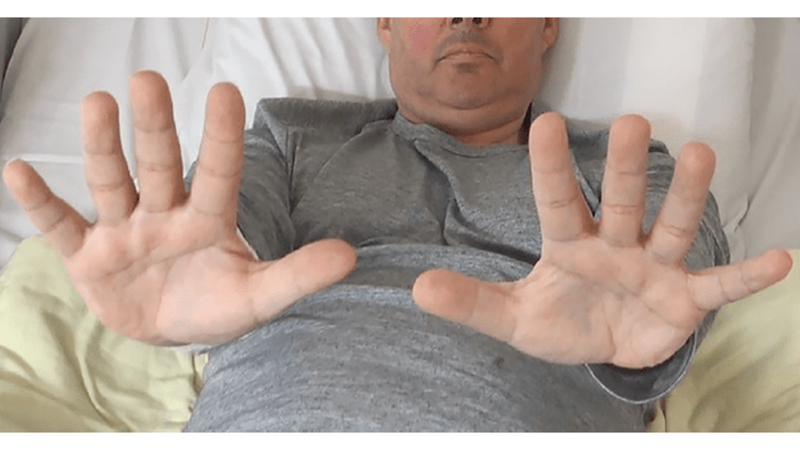 Video Case Report Action Myoclonus After CAR T Cell Therapy