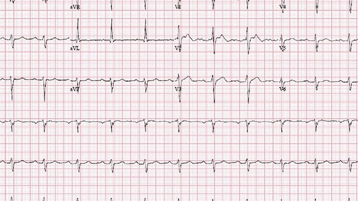 Challenge Case Report Left Sided Headache and Dizziness