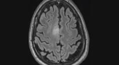 Challenge Case Report New Onset Seizures