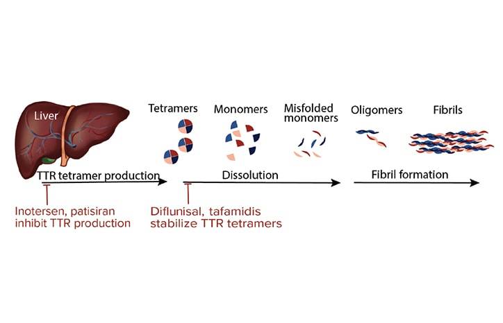 Transthyretin Familal Amyloid Neuropathy