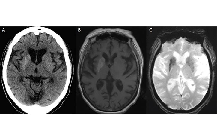 Case Report Hemichorea in a Woman With Diabetes