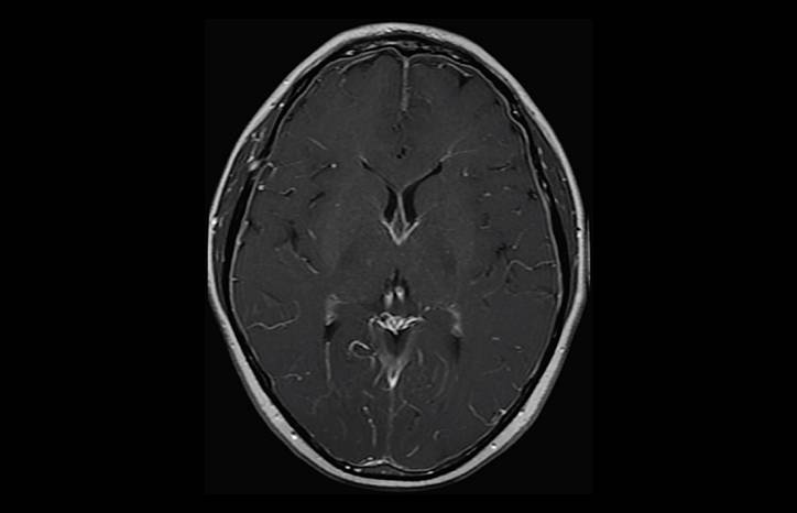 Case Report New Onset Headache With Tinnitus andOrthostatic Dizziness