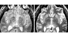 Movement Disorders Moment Asleep Deep BrainStimulation