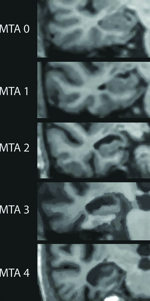 Mta Scale neuroimaging biomarkers in alzheimer disease & dementia