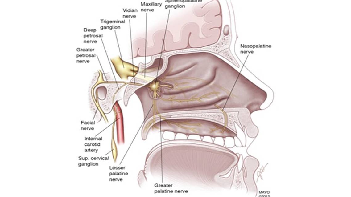 Sphenopalatine Ganglion Block Without Catheter