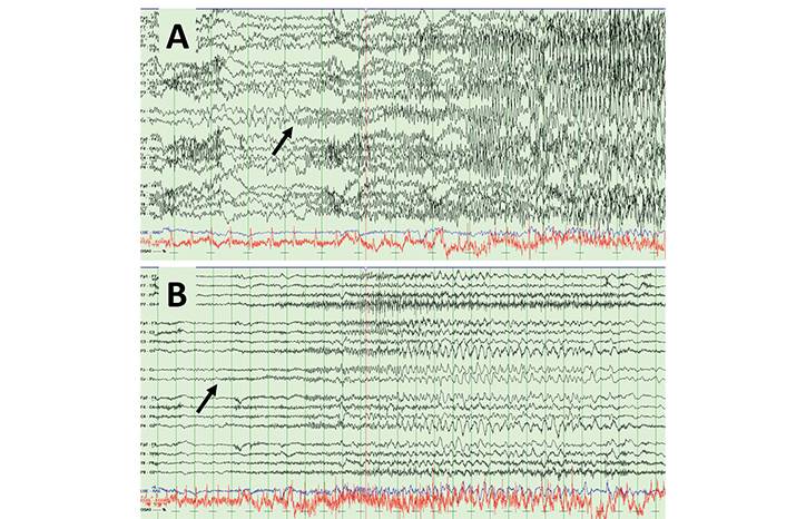 Spotlight on SleepDispelling the Sleep Spell Hypermotor Seizures Parasomnias and Leveraging Sleep Medicine in Pediatr