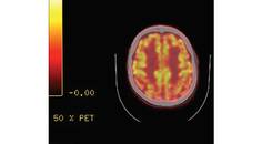 Symptoms of Lewy Body Dementia Induced by Herpes Zoster Encephalitis