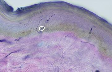 Utility of Skin Biopsy in Neuromuscular Disease