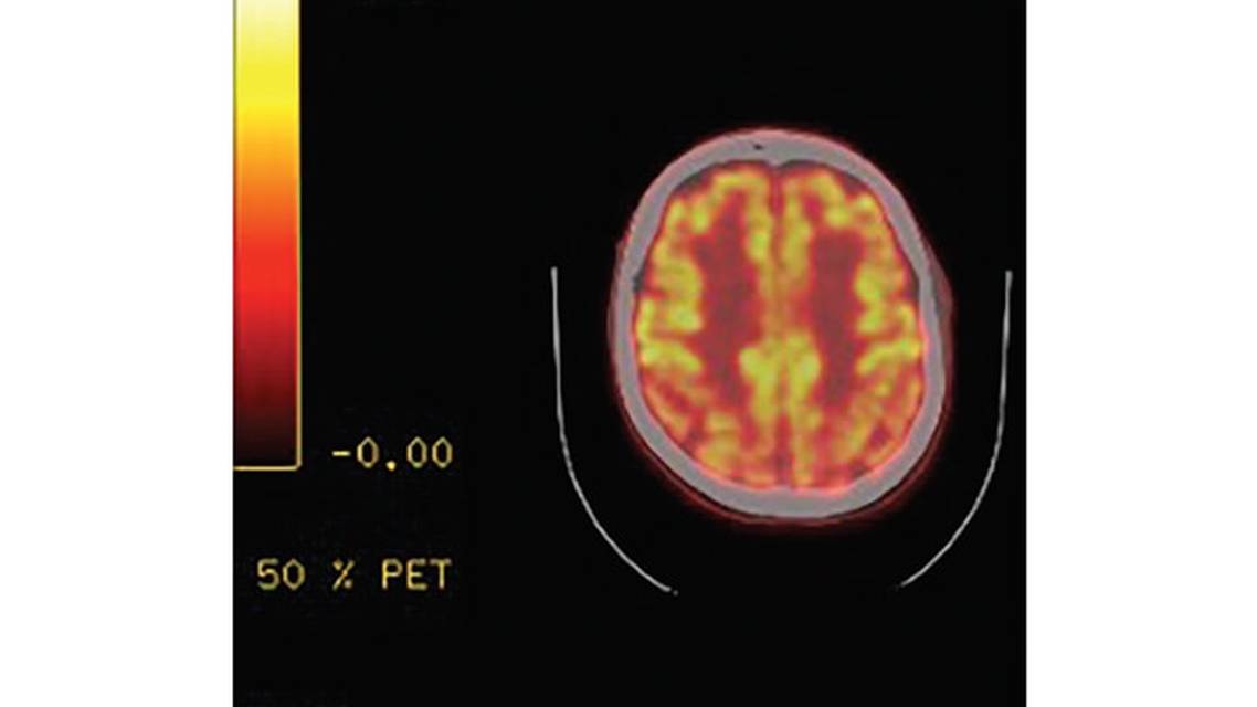 Symptoms of Lewy Body Dementia Induced by Herpes Zoster Encephalitis