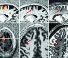 Figure 1 from the Epilepsy Essentials column article by Drs Ekert and Middlebrooks