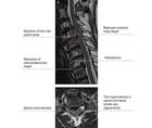 Degenerative Cervical Myelopathy as a Neuromuscular Mimicker