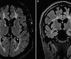 Case Report Hemiparkinsonism in a Patient With Multiple Sclerosis