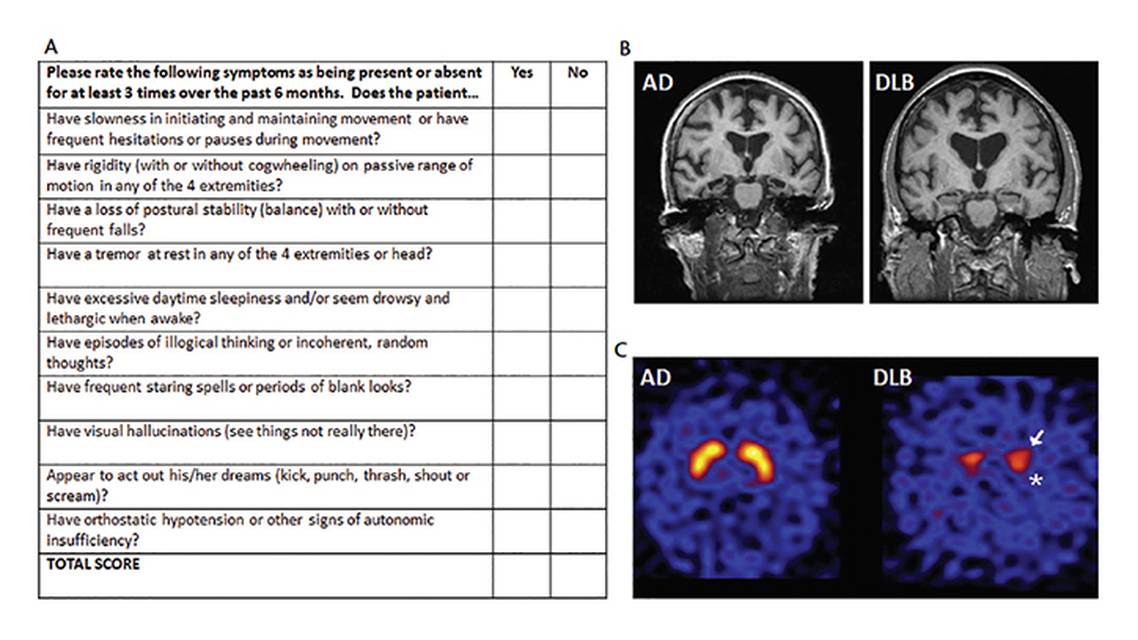 Lewy Body Dementia