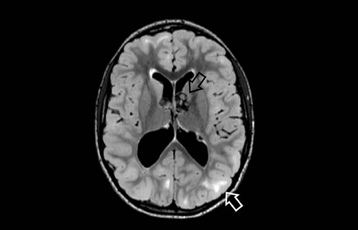 Tuberous Sclerosis Complex