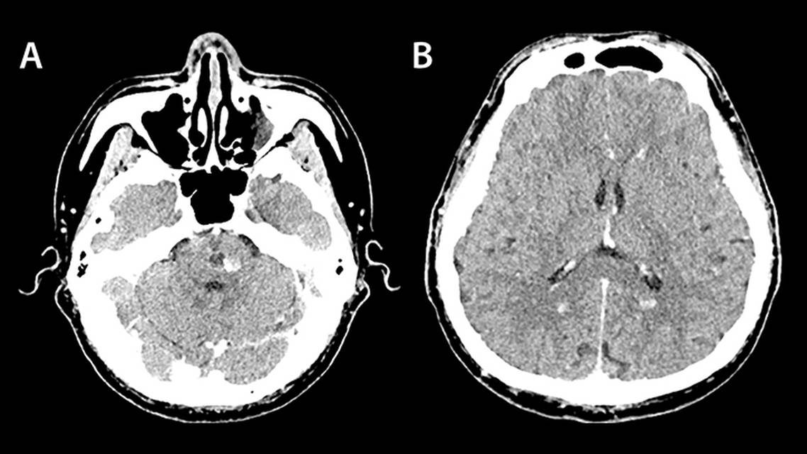 Familial Cerebral Cavernous Malformation