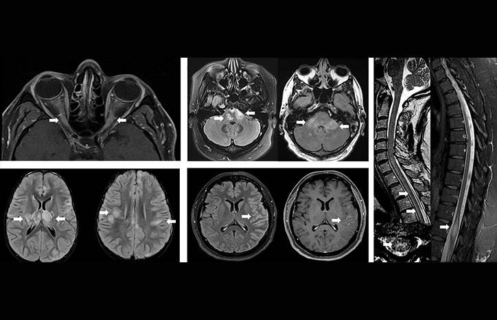 MS Minute Myelin Oligodendrocyte Glycoprotein AntibodyAssociated Disease