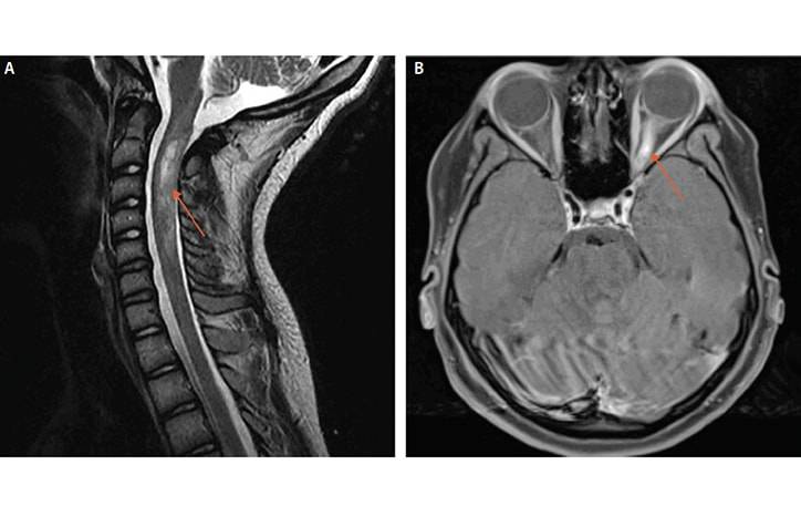 Antibody Mediated Inflammatory Central Nervous System Disorders of Childhood