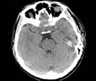 Challenge Case Report PostCOVID 19 Encephalitis