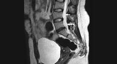 Tuberculous Radiculomyelitis