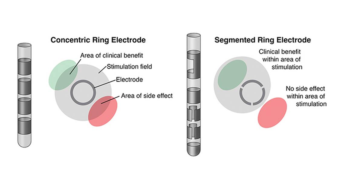 Movement Disorders Moment Deep Brain Stimulation in Movement Disorders Recent Advances and Future Directions