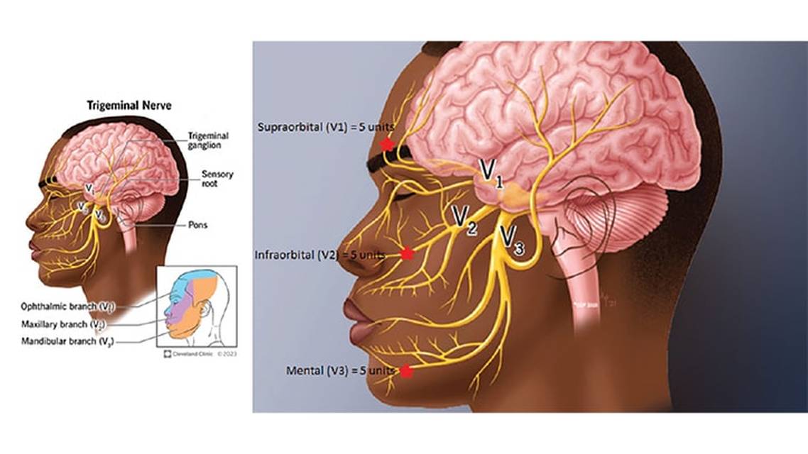 OnabotulinumtoxinA for Trigeminal Neuralgia Treatment