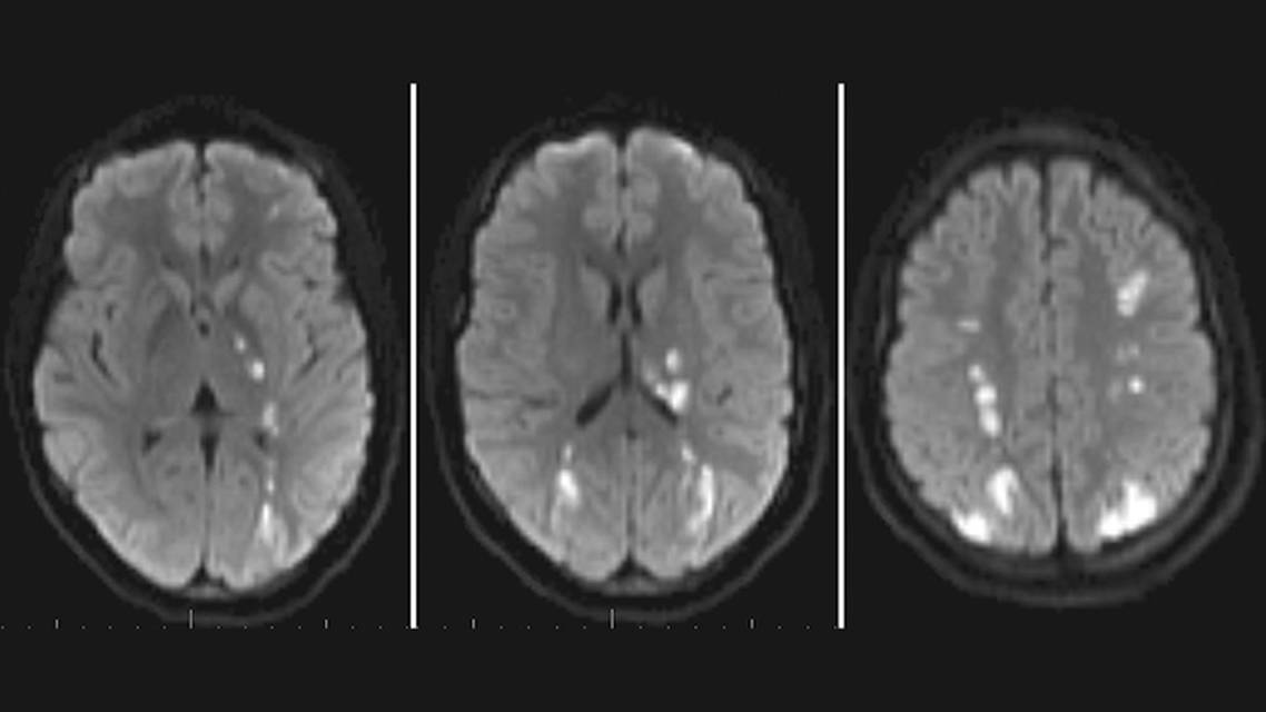 Stroke in a Young AdultImmunomodulation Responsive Bilateral Supraclinoid Carotid Artery Vasculopathy Secondary to Syste