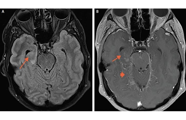 Case Report Seizure Fever Hallucinations and Vision Loss