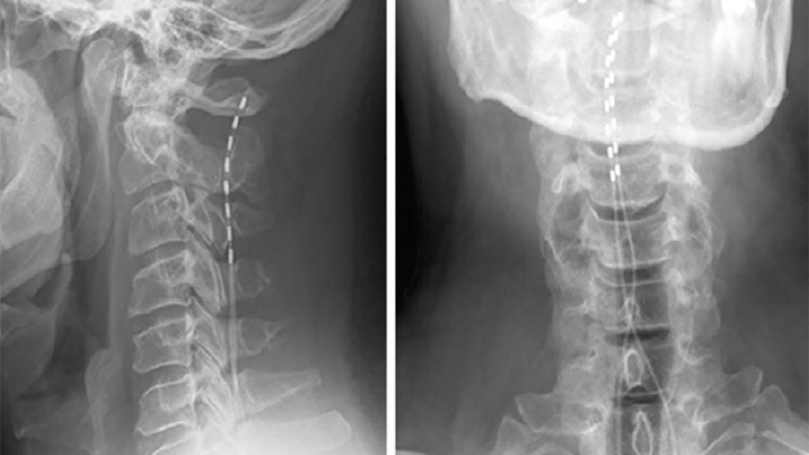 Implantable Neuromodulation for Chronic Pain and Headache