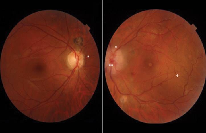 Cytomegalovirus and Herpes Simplex Virus Coinfection Neuroretinitis in an Immunocompetent Individual