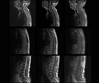 Case Report Occult Spinal Dural Arteriovenous Malformation