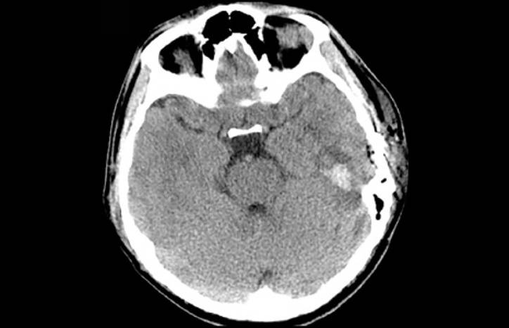 Challenge Case Report PostCOVID 19 Encephalitis