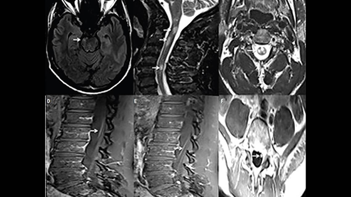 MOG Antibody Disease