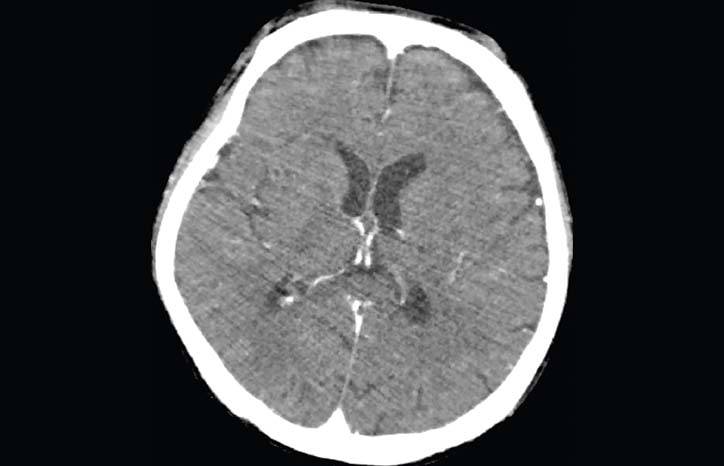 Eosinophilic Meningitis After Eating Freshwater Snails