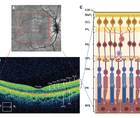MS Minute Retinal Optical Coherence Tomography for MS