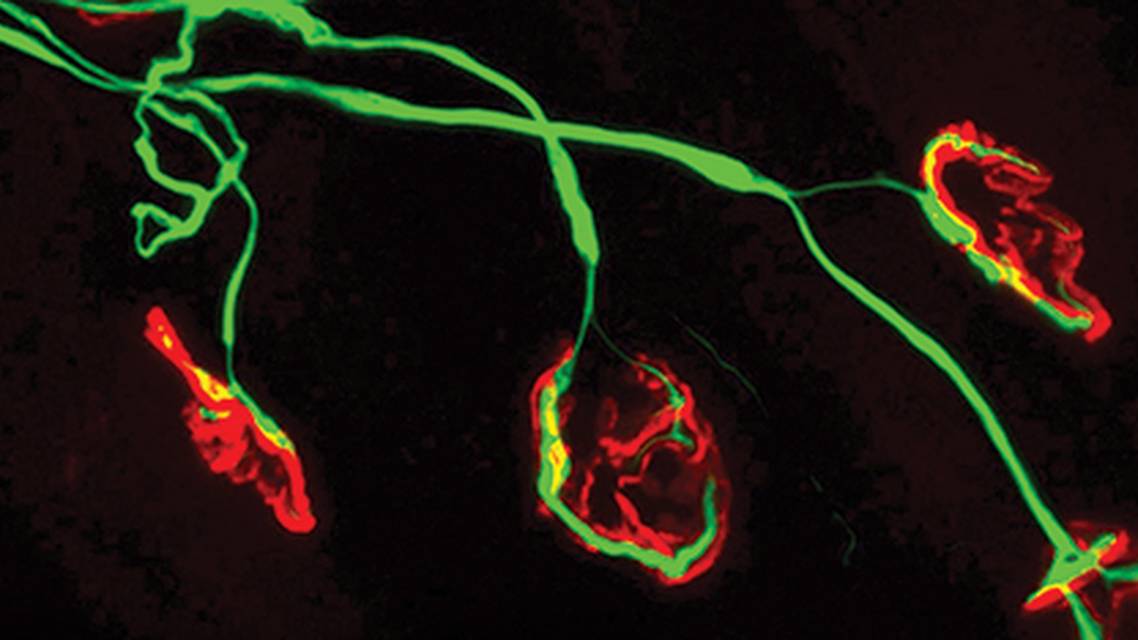 Sporadic Inclusion Body Myositis