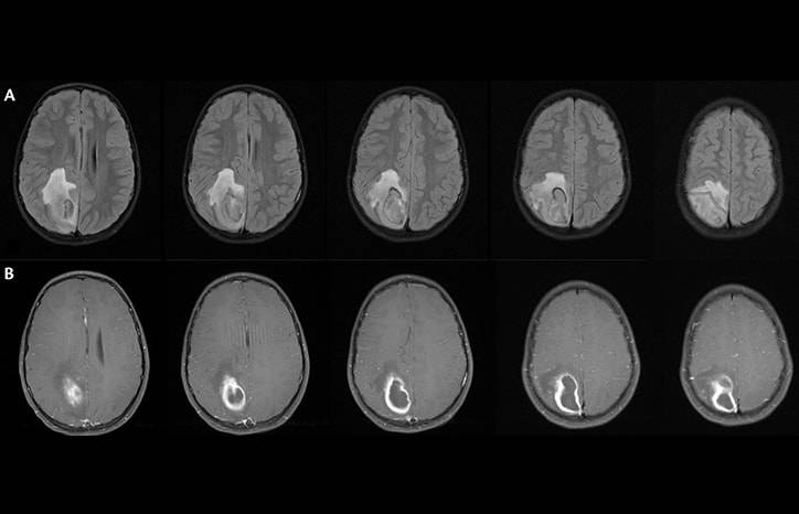 Focal Status Epilepticus 9 Years After Brain Abscess