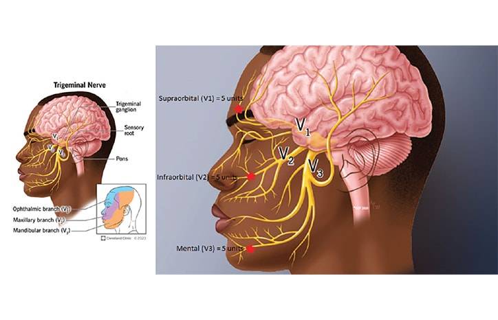 OnabotulinumtoxinA for Trigeminal Neuralgia Treatment