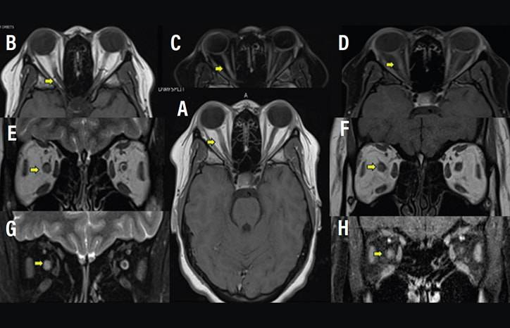 Neuro Ophthalmology Notions The Optic Nerve as Topographic Marker in the 2024 McDonald Diagnostic Criteria for Multiple Scle