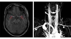 Ischemic Complications from a Facial Lipofilling Procedure
