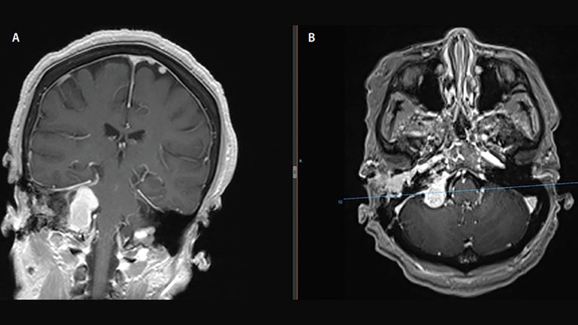 Case Report A Woman with Tinnitus and Tongue Atrophy