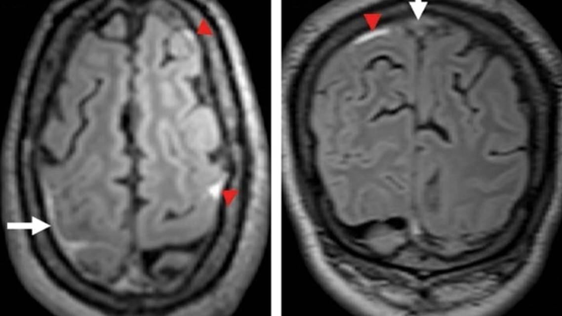 Cerebral Venous Thrombosis Presenting as Recurrent Transient Ischemic AttackLike Episodes