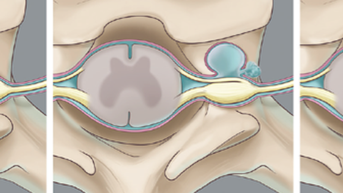 Spontaneous Intracranial Hypotension