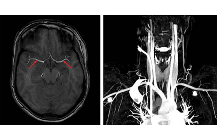 Ischemic Complications from a Facial Lipofilling Procedure