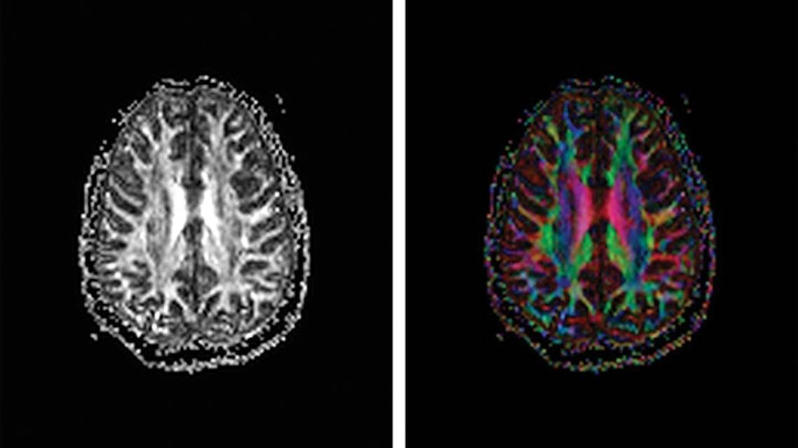 TBI Today Quantitative Diffusion Tensor Imaging for Assessment of Mild Traumatic Brain Injury