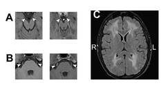 Case Reports Mitochondrial Neurogastrointestinal Encephalopathy