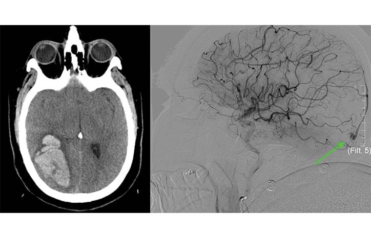 Spontaneous Intracranial Hemorrhage Secondary to Rare Pial Arteriovenous Fistula Rupture