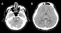 Familial Cerebral Cavernous Malformation