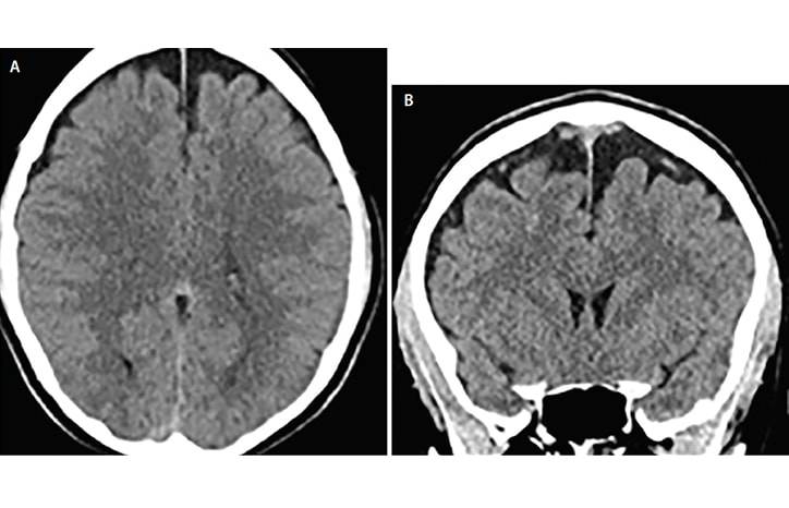 Case Report Delayed Subdural Hematoma