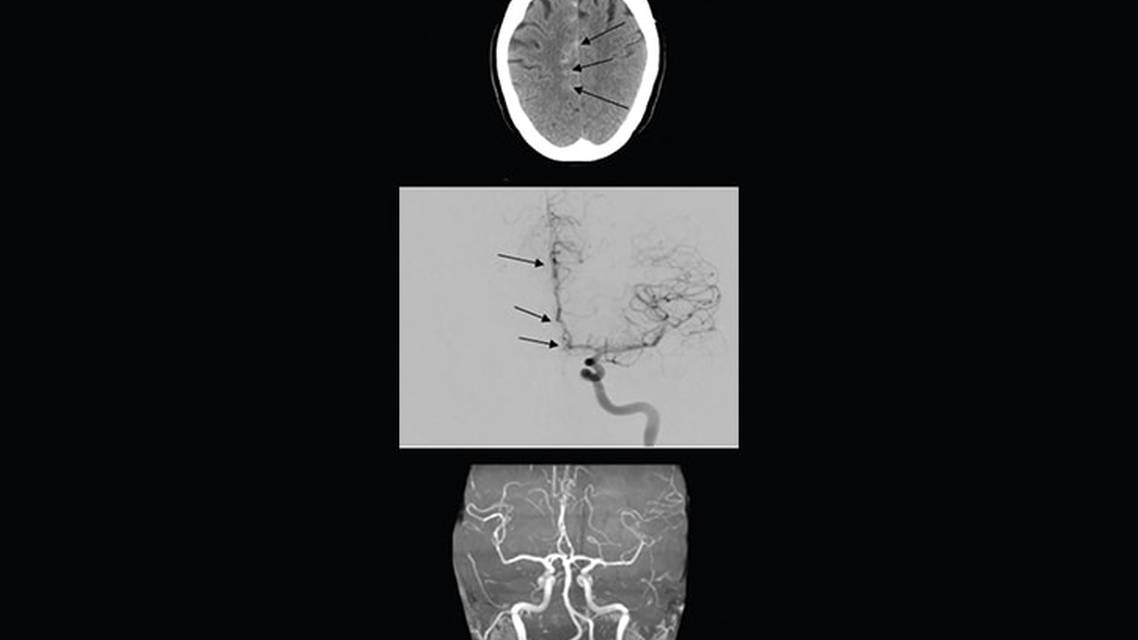 Headache Horizons Reversible Cerebral Vasoconstriction Syndrome Presentation Diagnosis and Treatment of a Complex Neurova