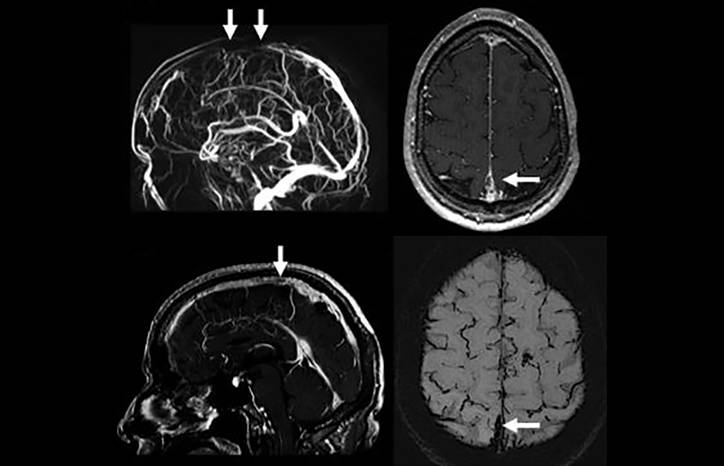 Headaches Not to Miss Regardless of the Patient Population Thunderclap Headache in the Emergency Department